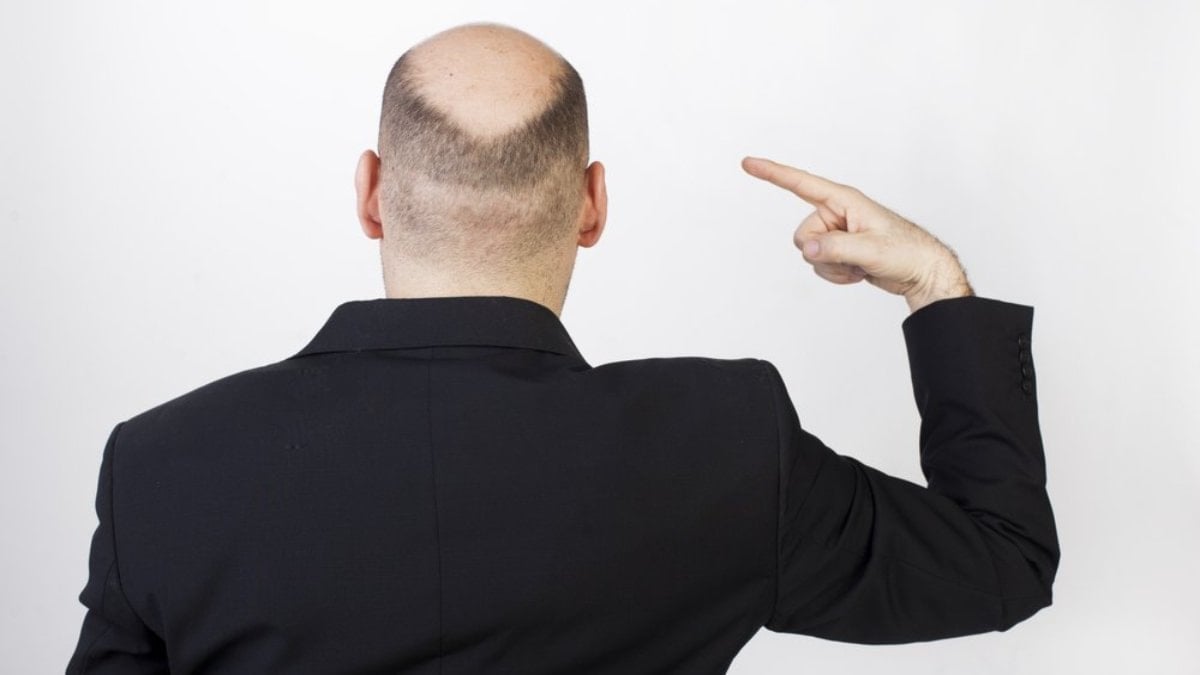 Bilim insanlarından şaşırtan iddia: Kel kalma olasılığını böyle tespit ettiler