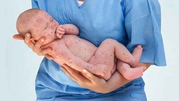 Kızamık salgını için bir tek Bakanlık suskun