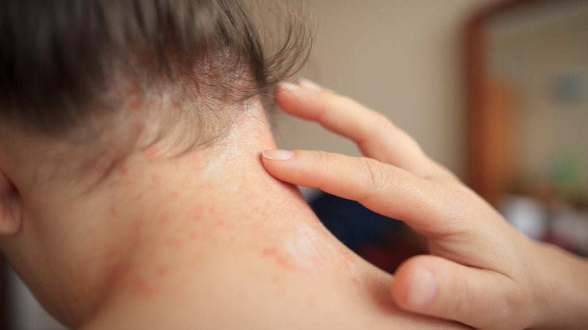 Vitiligo hastaları güneşe çıkabilir mi?