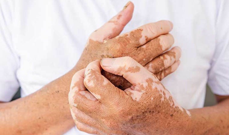 stres ve travmalar vitiligo hastaligini tetikliyor wVnOBUcM