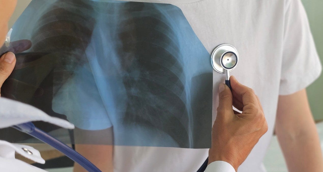 Uzmanı uyardı: HMPV virüsü bronşit ve zatürre riskini artırabilir!