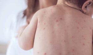 Ebeveynler dikkat! Alerjisi olan çocuklar daha kolay enfekte oluyor! Uzmanlardan korunma önerileri…