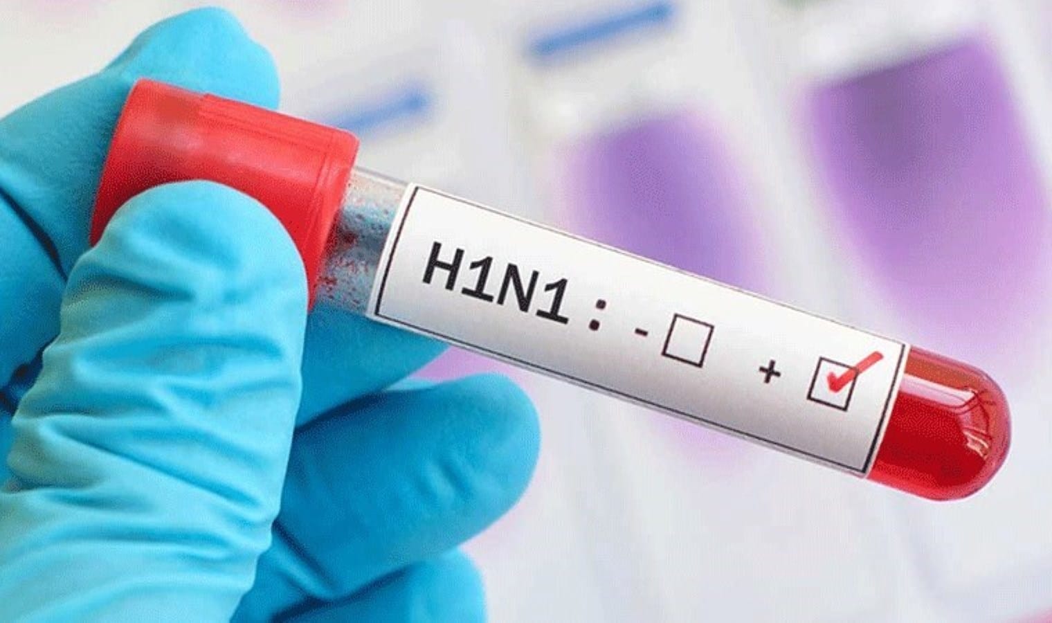 Sağlık çalışanının ölümü endişe yarattı: Domuz gribi (H1N1) hızla yayılıyor! Domuz gribinin belirtileri nelerdir? Ne kadar sürede geçer?