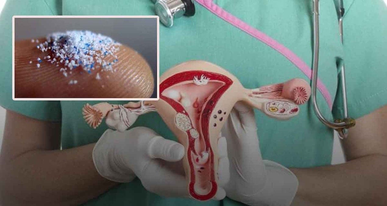 Kadınların yumurtalıklarından alınan sıvıda mililitre başına binlerce mikroplastik parçacığı bulundu